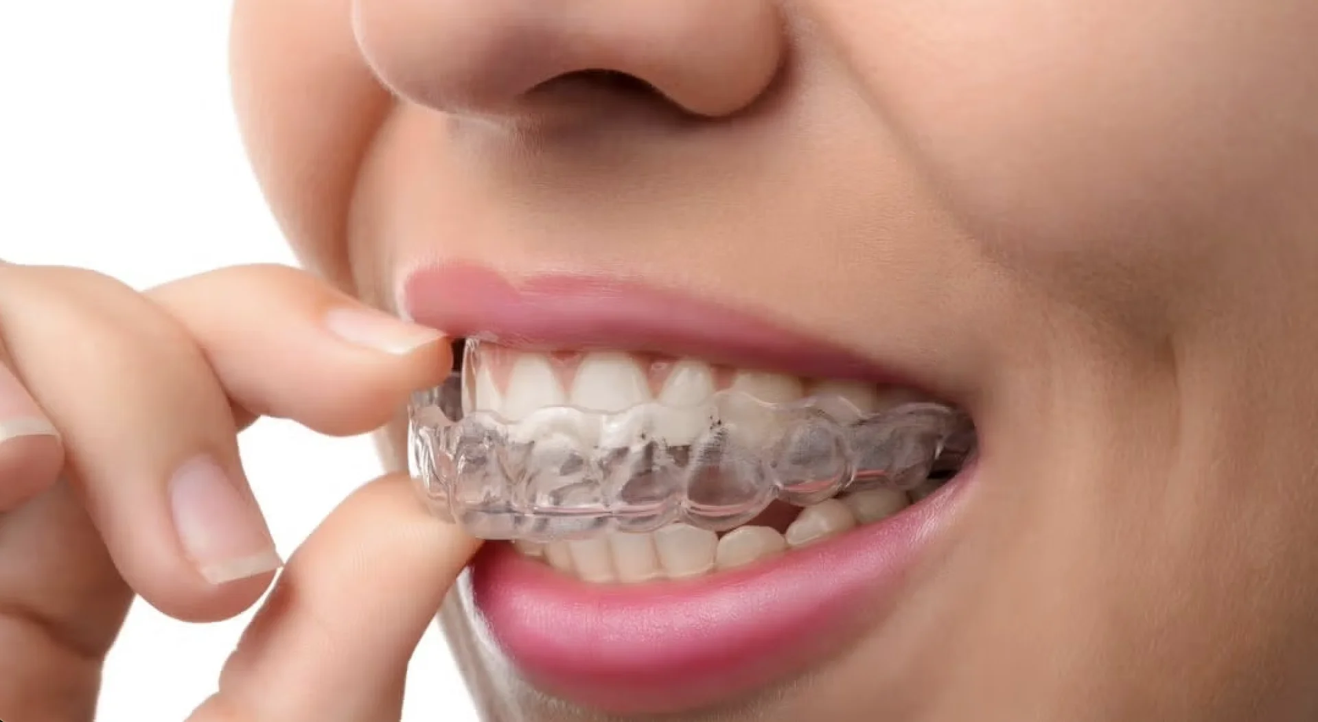 Выравнивание зубов