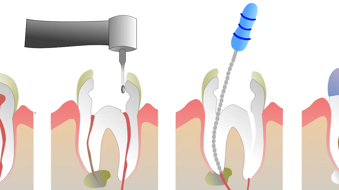 Root canal treatment