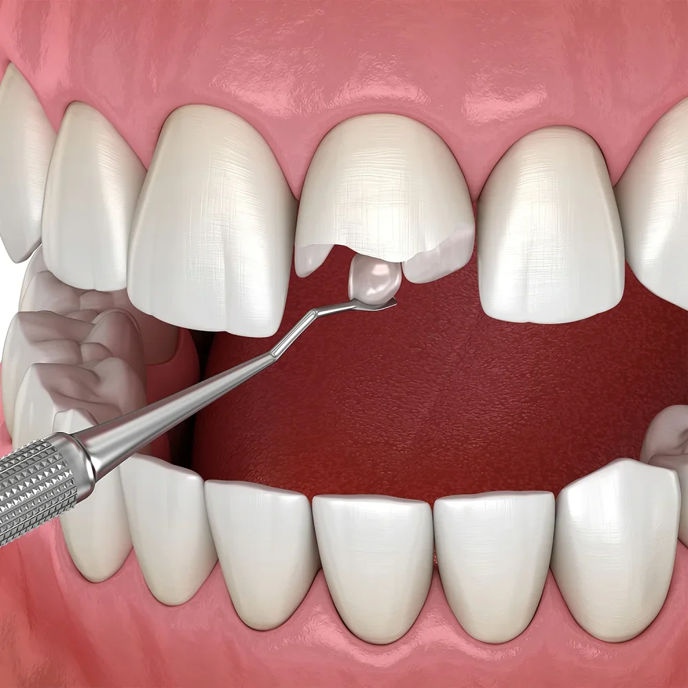 Эстетическое пломбирование - результат